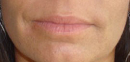 Kristy before Blended Lip Liner enhancement